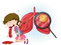 Ilustrasi: Tubercolosis