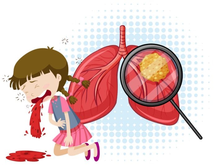 Ilustrasi: Tubercolosis